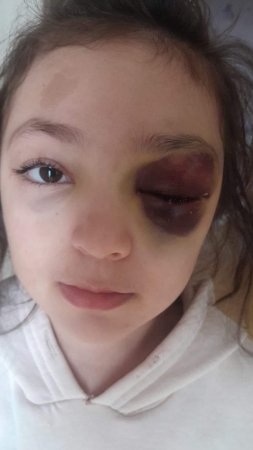 Müəllim adına NÖVBƏTİ LƏKƏ: Ramanadakı məktəbdə azyaşlı qız uşağını tanınmaz hala kim salıb? - FOTOLAR Müəllim adına NÖVBƏTİ LƏKƏ: Ramanadakı məktəbdə azyaşlı qız uşağını tanınmaz hala kim salıb? - FOTOLAR