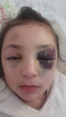 Müəllim adına NÖVBƏTİ LƏKƏ: Ramanadakı məktəbdə azyaşlı qız uşağını tanınmaz hala kim salıb? - FOTOLAR Müəllim adına NÖVBƏTİ LƏKƏ: Ramanadakı məktəbdə azyaşlı qız uşağını tanınmaz hala kim salıb? - FOTOLAR